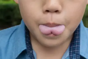 What Does Tongue Tie Look Like in Babies vs Normal?