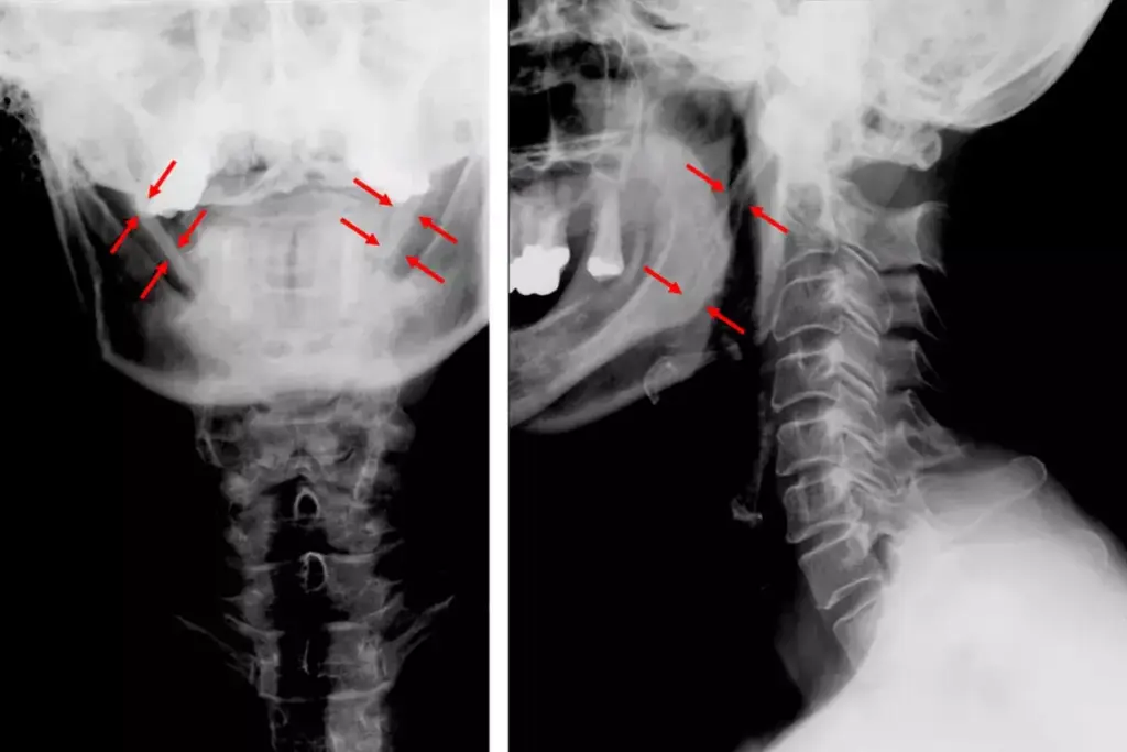 How to Recognize Congestion Symptoms: Key AP Findings 3 How to Recognize Congestion Symptoms: Key AP Findings