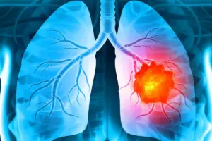 Lung Cancer Symptoms: Deadly Early Signs