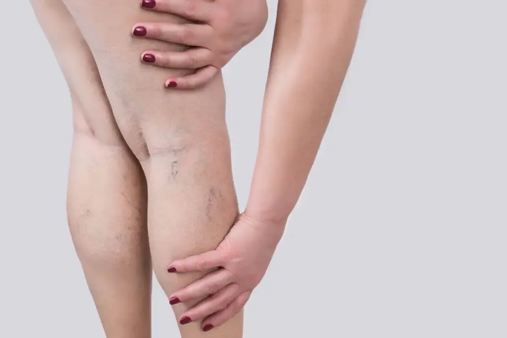 What Causes Varicose Veins In Legs: Facts 1 What Causes Varicose Veins In Legs: Facts