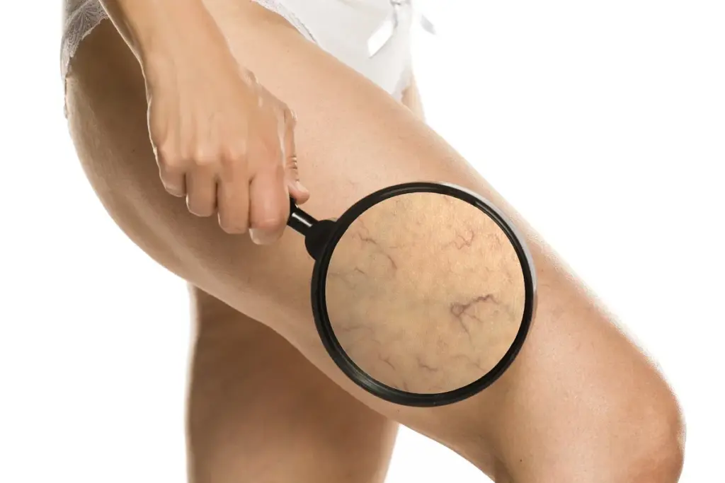 What Causes Varicose Veins In Legs: Facts 2 Understanding Varicose Veins: A Common Vascular Condition