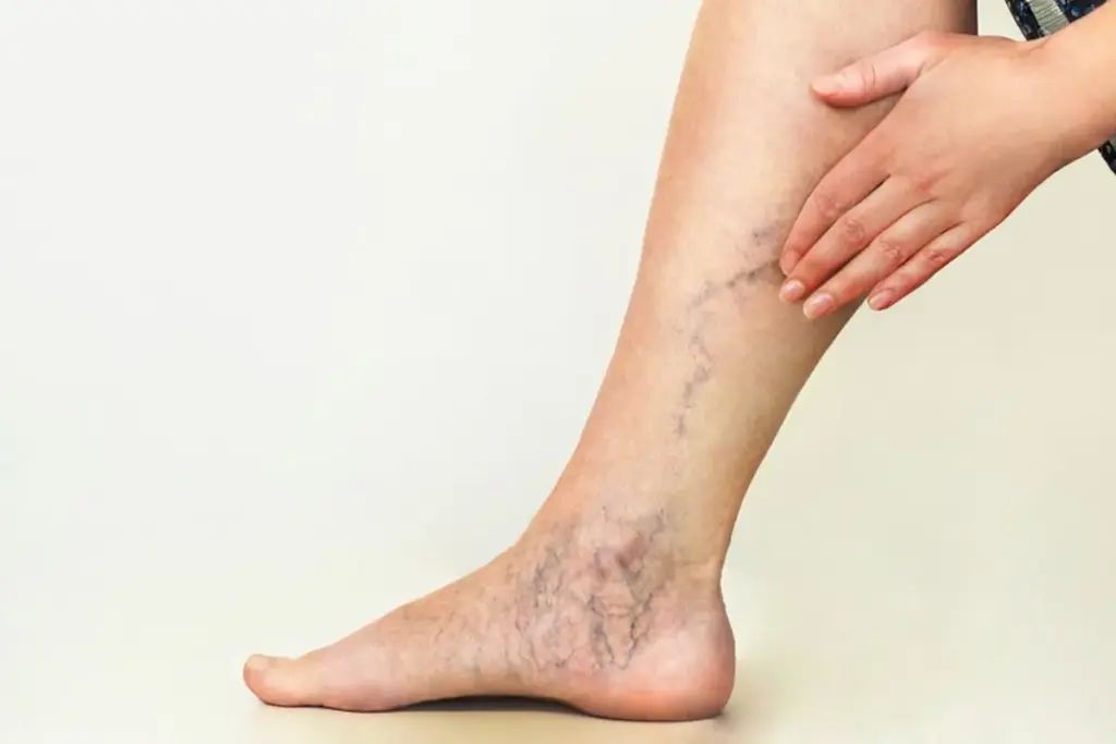 Understanding Varicose Veins: Causes and Symptoms