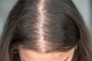 TACE: Vital Truth About Hair Loss Risks