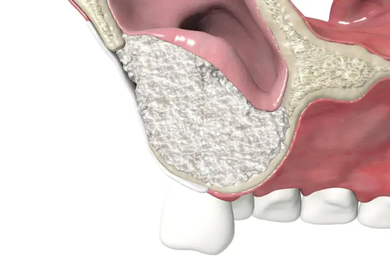 How to Treat Tympanic Membrane Perforation