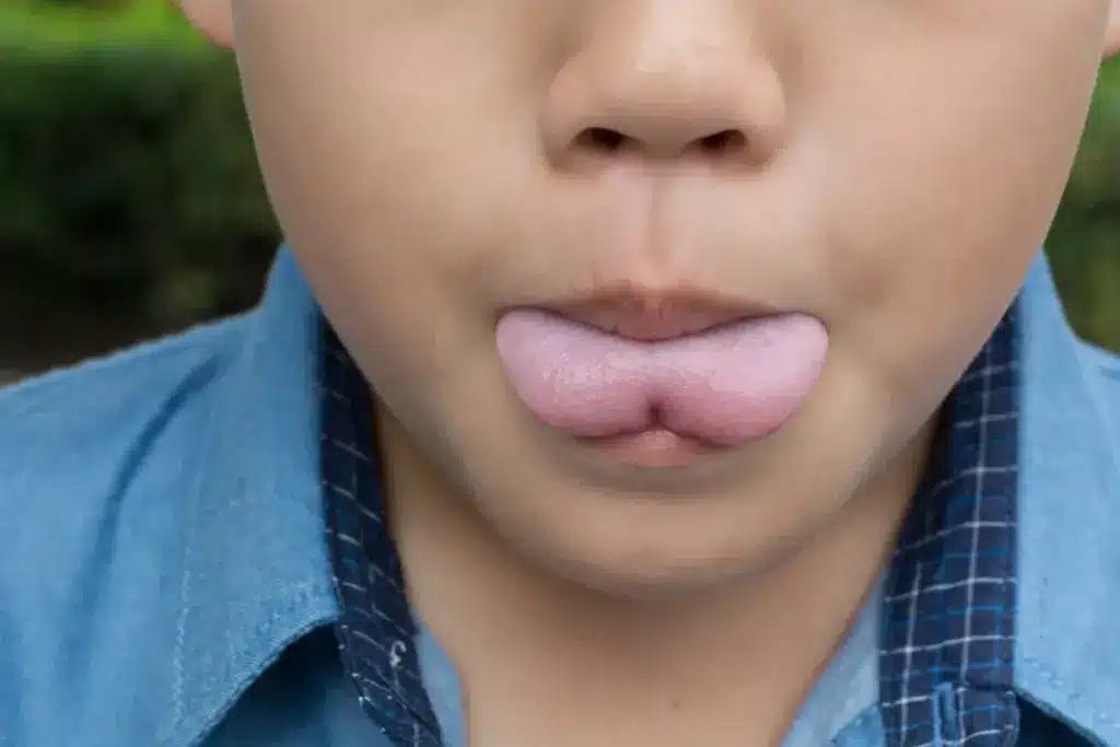 What Does Tongue Tie Look Like in Babies vs Normal?