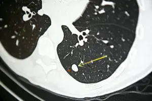 Can A Lung Biopsy Cause Cancer To Spread: Facts