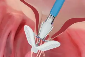 Mitraclip: Brilliant Facts On Heart Repair