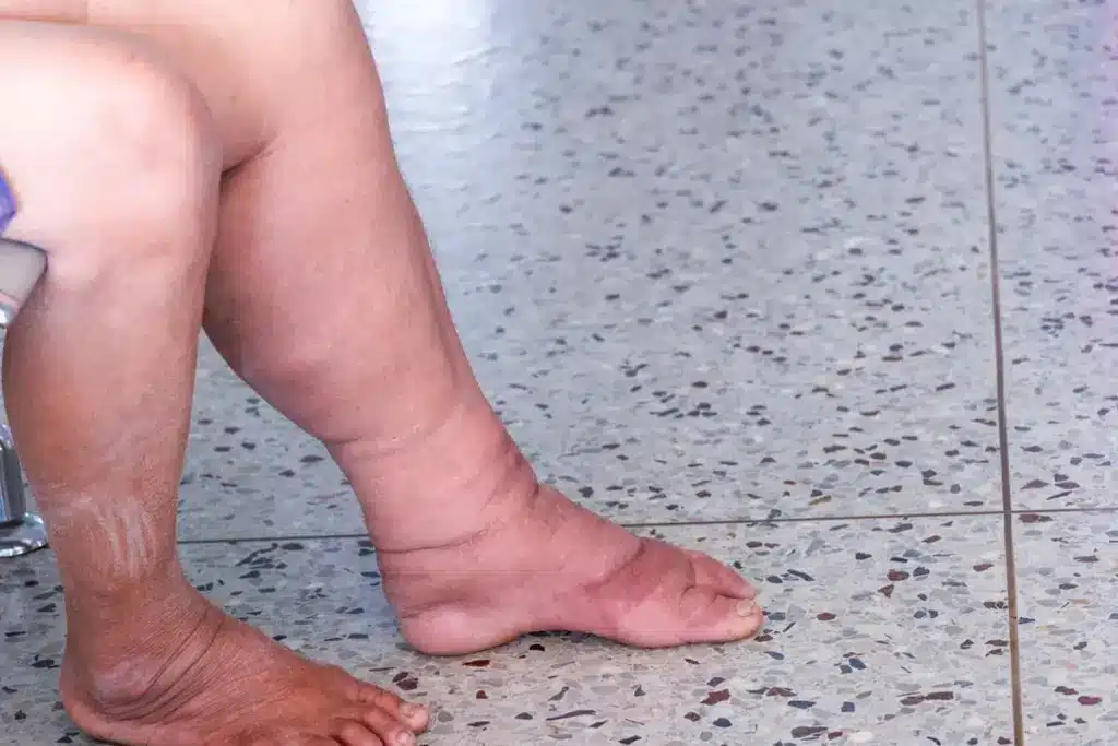 Lymphedema: Essential Tips To Avoid Risky Pain