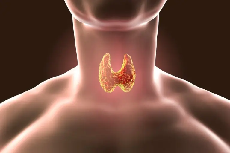 Hypothyroidism: Best Essential Weight Tips