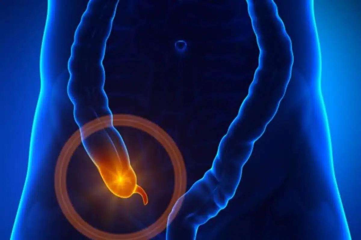 Appendicitis Symptoms: Proven Guide To 5 Stages