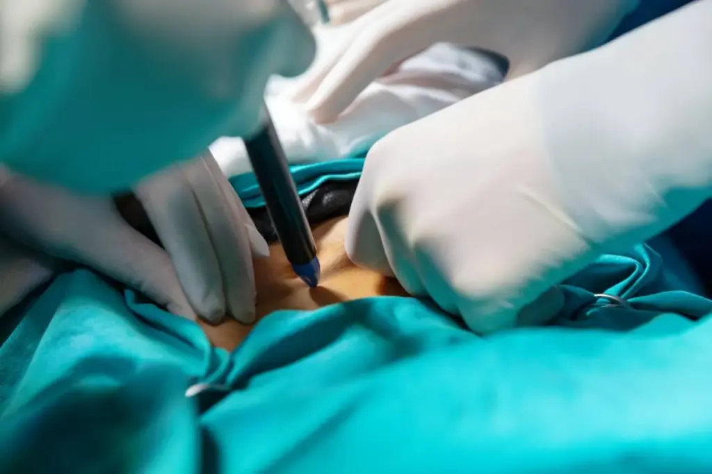 Laparotomy: Best Essential Guide To Terms