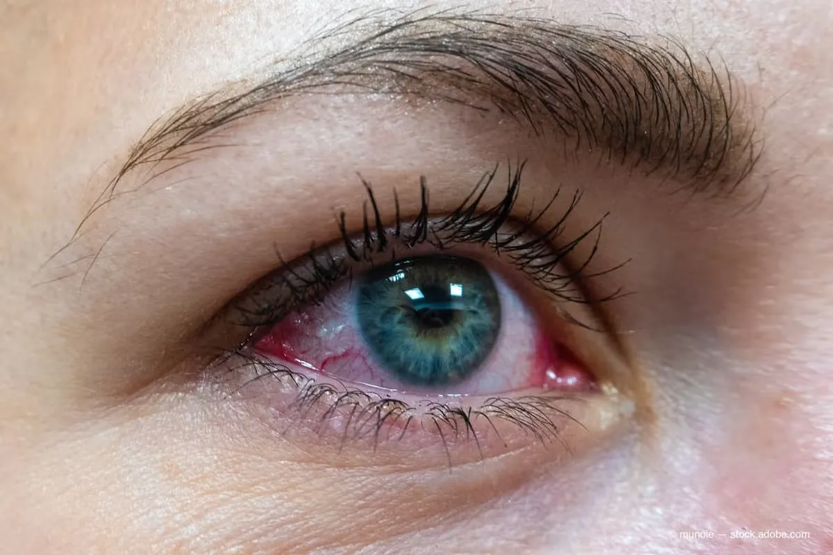 Can You Buy Pink Eye Medicine Over the Counter?