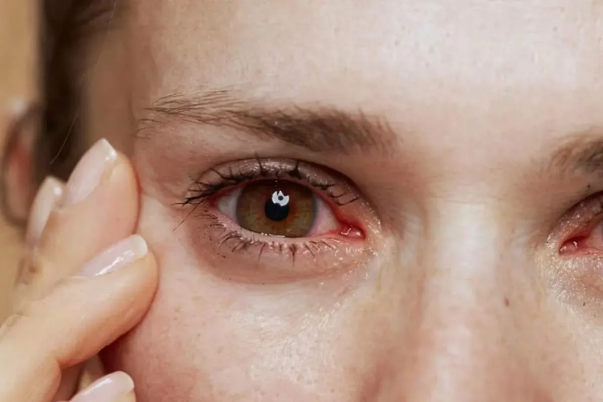 How to Treat Gonococcal Conjunctivitis in Newborns