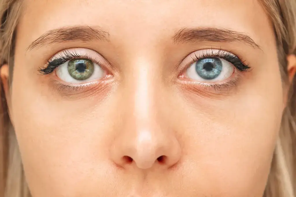 Eye Exercises for Diplopia: How They Work