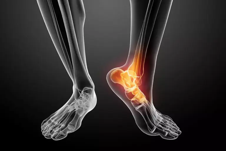 7 Clear Signs of Ankle Arthritis: Pictures & X-Ray Guide