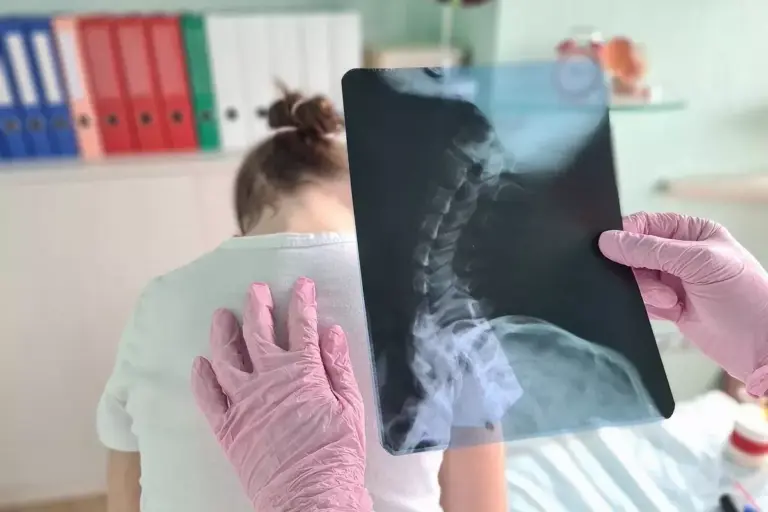 How to Read Ankylosing Spondylitis X-Ray Results