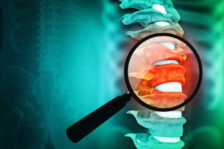 What’s the Difference Between Spondylosis and Ankylosing Spondylitis?