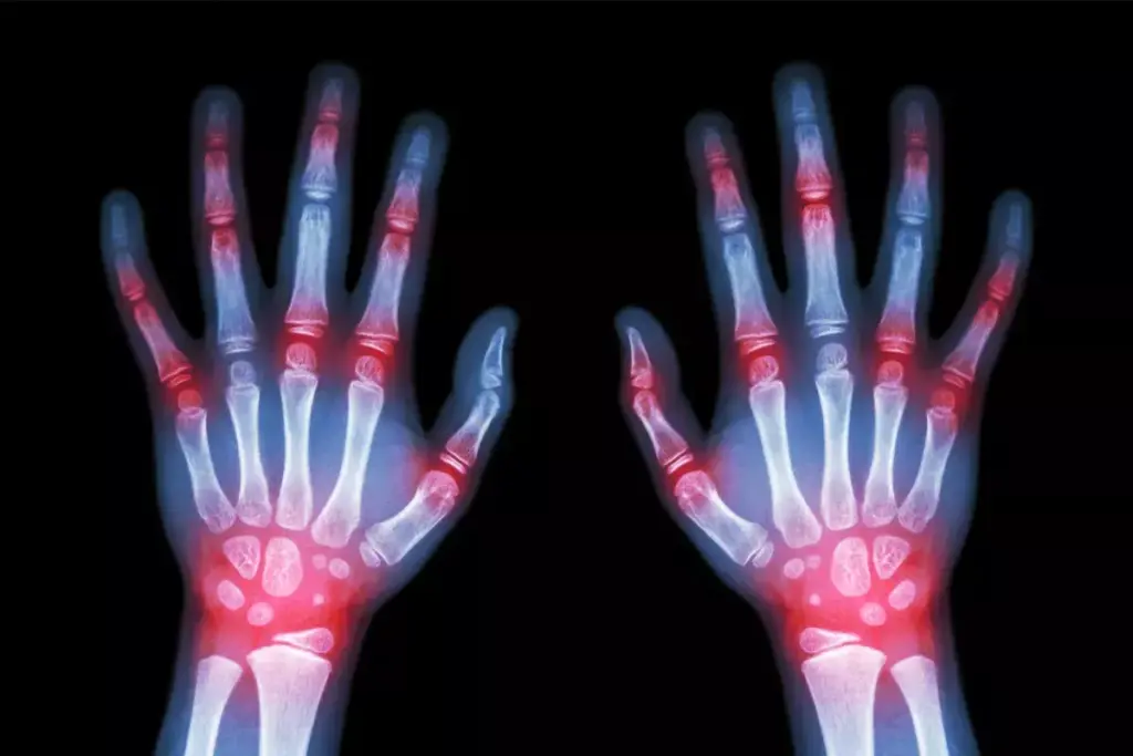 What Are Rheumatoid Nodules and Why Do They Form? 1 image 3178 LIV Hospital