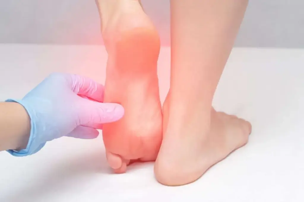 Can You Get Gout in Your Heel? Causes and Relief 1 Can You Get Gout in Your Heel? Causes and Relief