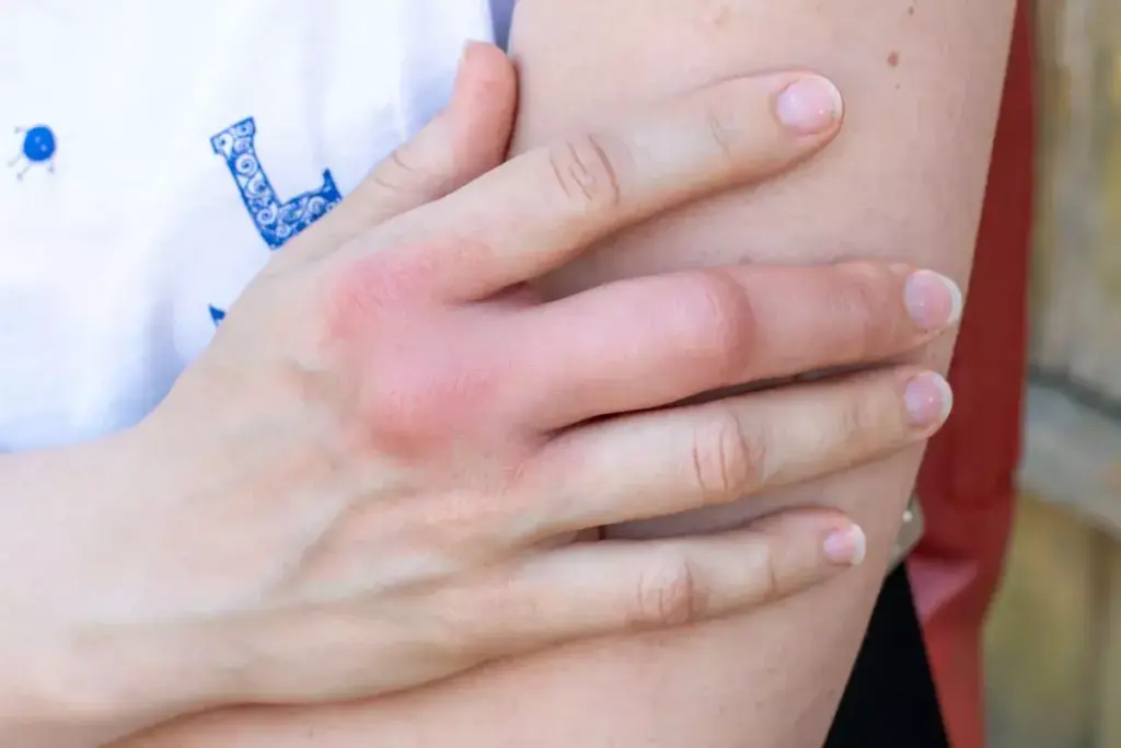 7 Foods to Avoid With Gout: Nuts, Shellfish & More 2 Understanding Gout and How Diet Affects Uric Acid Levels