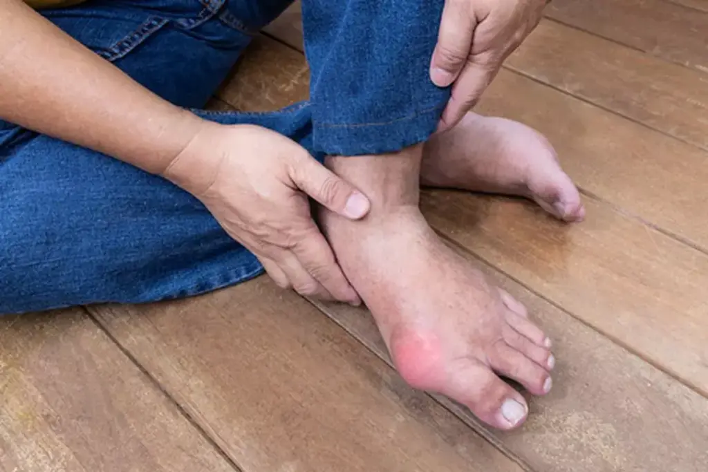 Understanding Gout and Its Causes