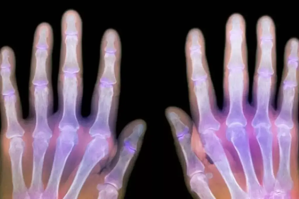 Understanding Rheumatoid Factor Basics