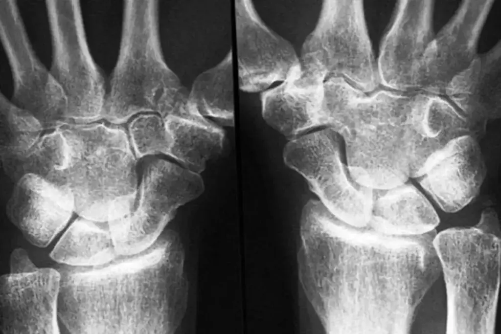 Understanding Rheumatoid Factor and Its Significance