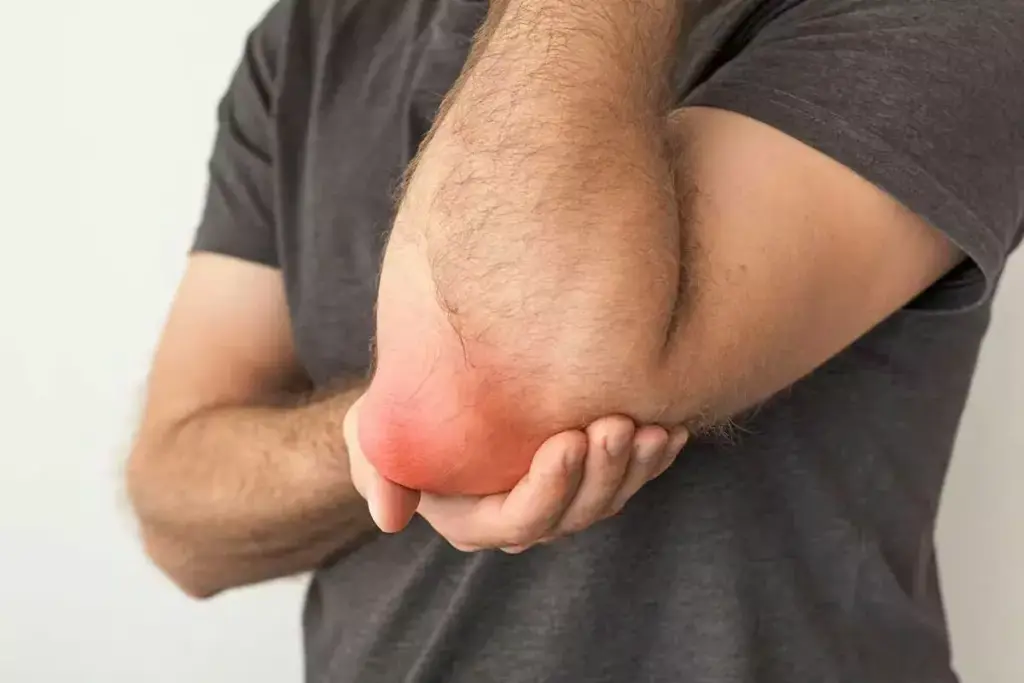 Understanding Elbow Bursitis