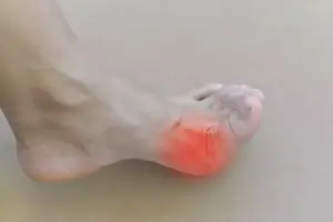 How to Treat Tophaceous Gout: A Complete Guide