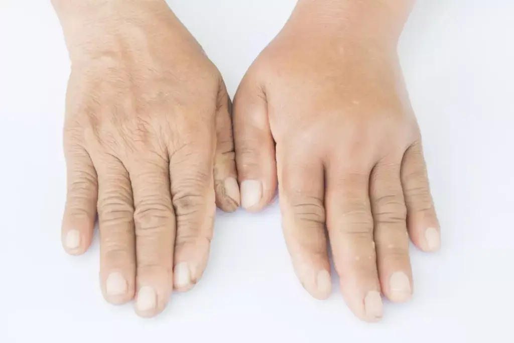 Physiological Causes of Waking Up With Puffy Hands