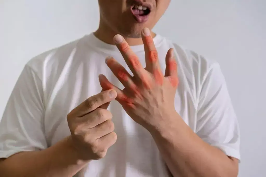 Understanding Gout and Dietary Triggers