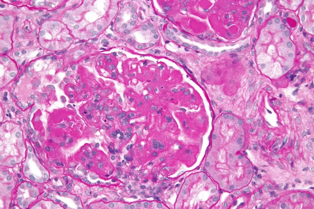 What Is Acute Interstitial Nephritis and What Causes It?