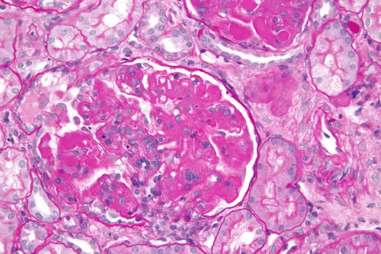 What Is Acute Interstitial Nephritis and What Causes It?