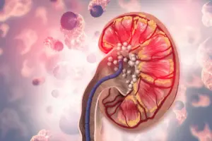 5 Types of Kidney Stones: Calcium Phosphate and More Explained