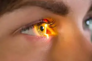 How to Treat Angle Closure Glaucoma: A Step-by-Step Guide