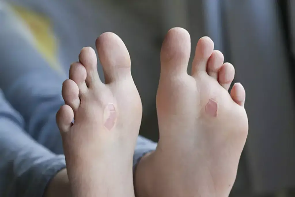 Step-by-Step Treatment for Diabetic Blister on Toe and Feet