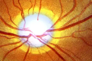 hat Is Normal Tension Glaucoma and How Is It Treated?