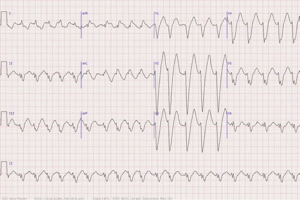 What Is An Arrhythmia? Understanding Irregular Heartbeats