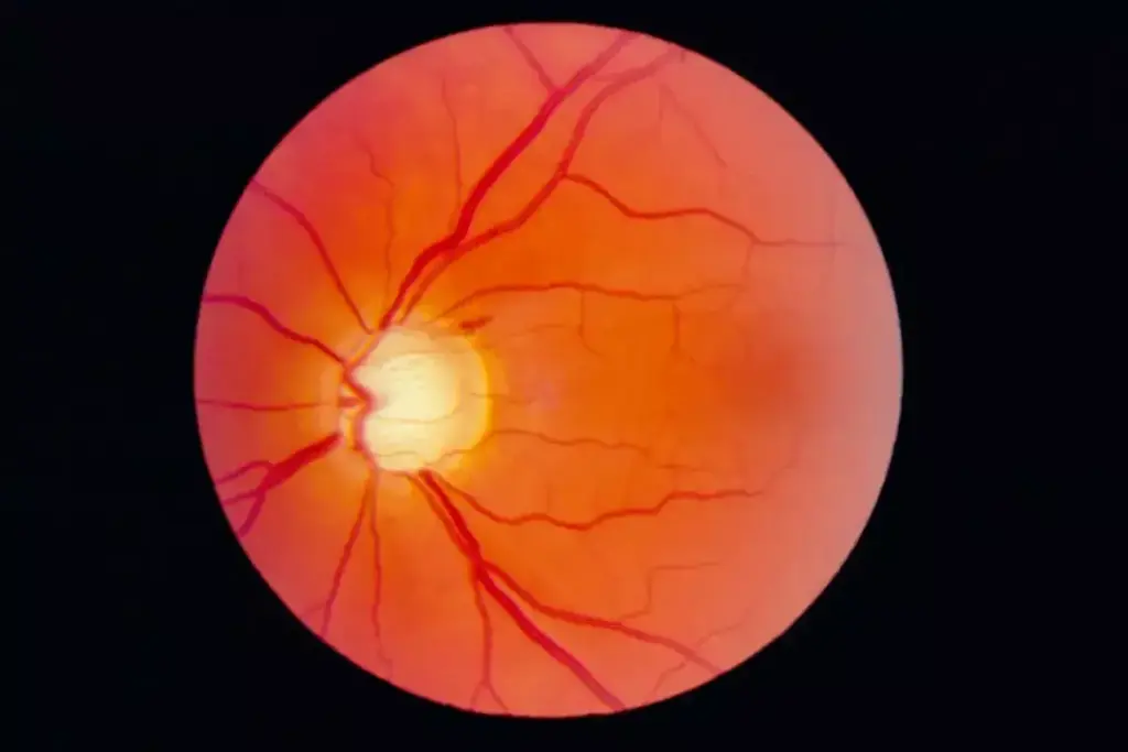 What Is Optic Nerve Cupping and How Does It Relate to Glaucoma? 3 Glaucoma Cupping: How Elevated Pressure Damages the Optic Nerve