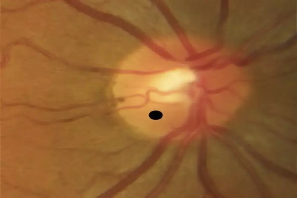 What Causes Fluid on the Optic Nerve and Swelling?