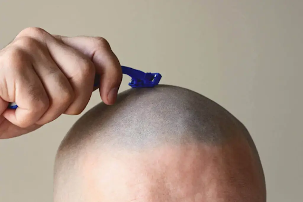 Brain Operation: Simple Guide To Preparation 3 The History of Head Shaving for Brain Operations