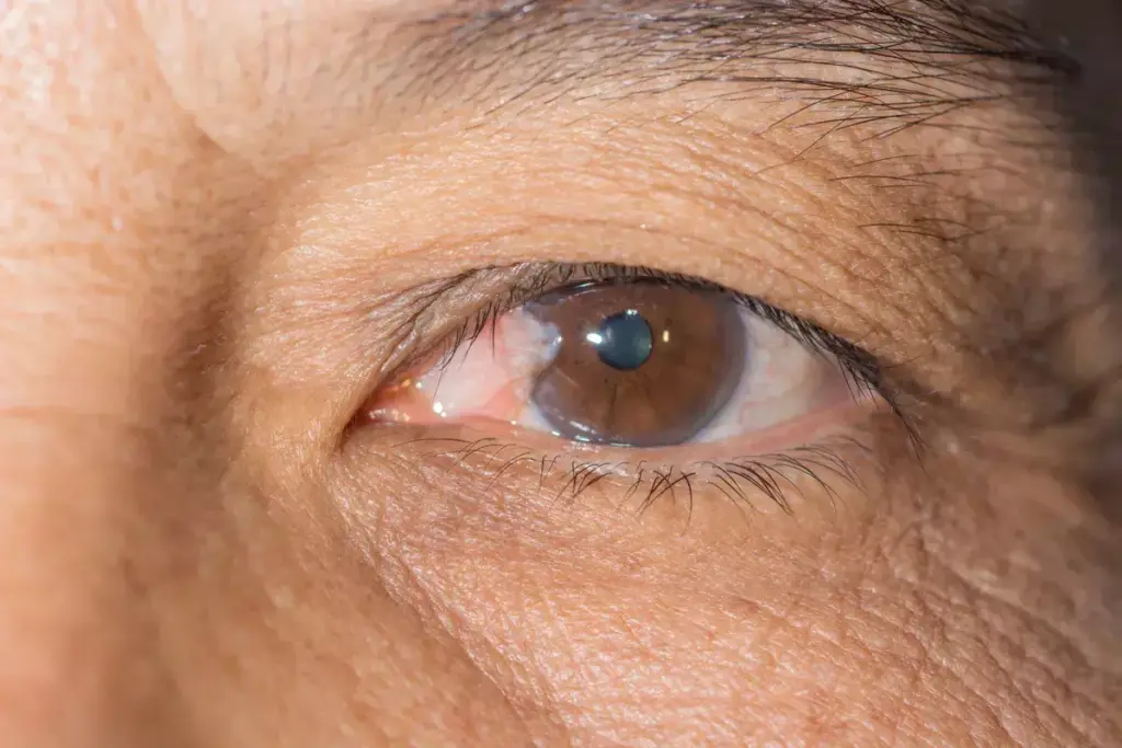 Why Glaucoma Is Called the Silent Thief of Sight
