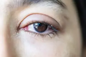 Why Is My Eye Red and Watery? Causes and Treatments