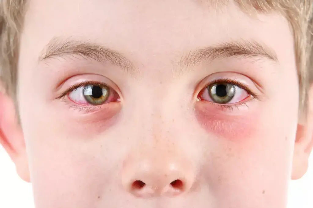 Understanding Eye Redness: Anatomy and Appearance