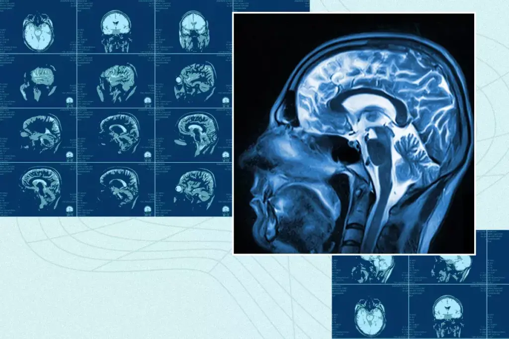 5 Essential Dementia Screening Tests for Early Detection