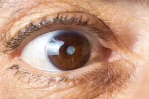 What is a Cataract? Definition, Symptoms & Vision Effects