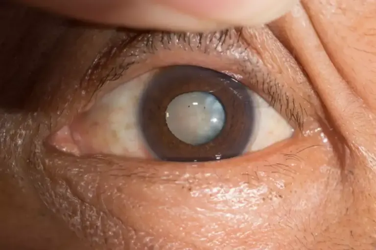 How to Manage Acute Narrow Angle Glaucoma: Key Steps