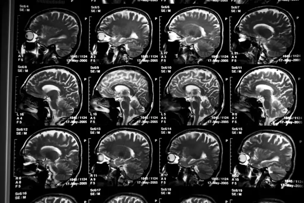 5 Essential Dementia Screening Tests for Early Detection
