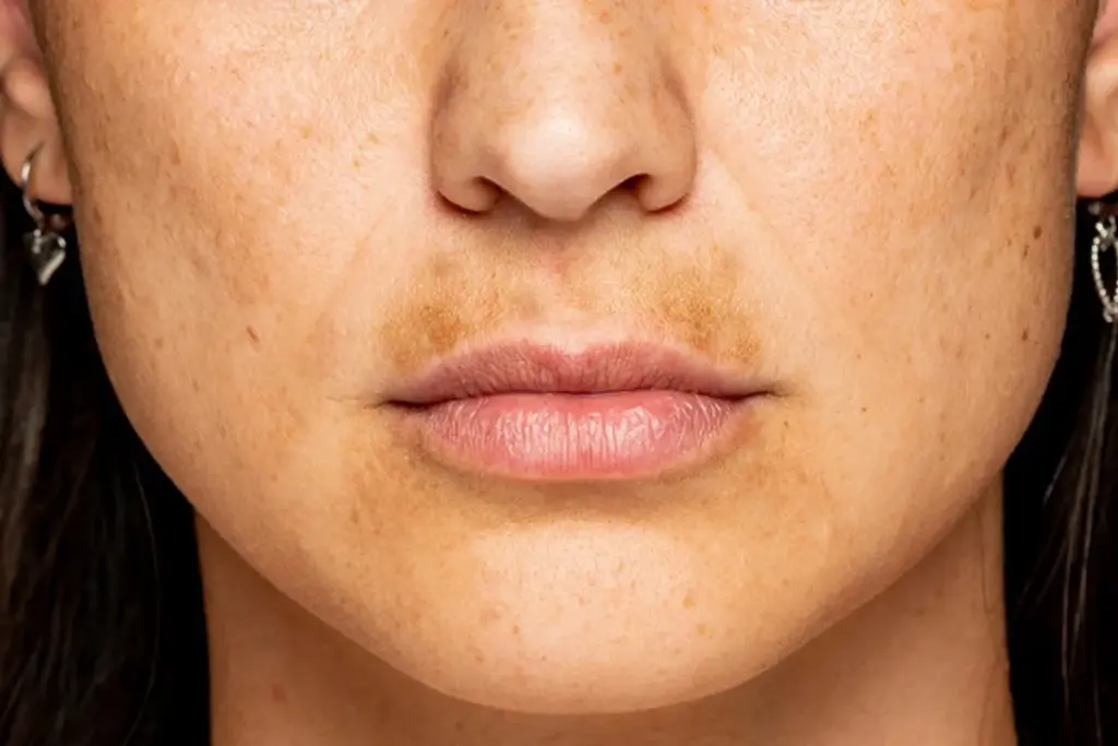 Where Does Hyperpigmentation Come From?