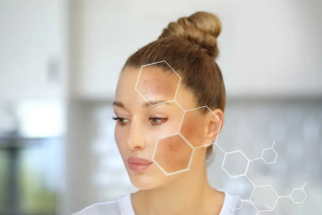 Understanding Pigmentation Disorders